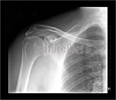 Shoulder-Xray-752382.jpg